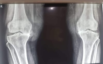 Know About Joint Replacement Surgery in India