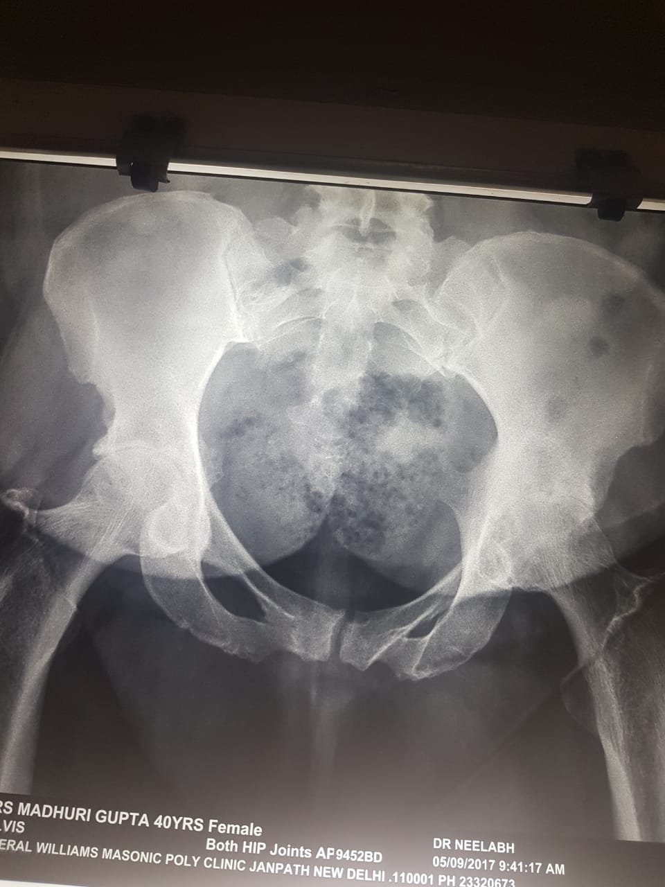 Hip Replacement Surgery in India