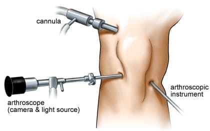 KNEE-REPLACEMENT-SURGERY-IN-INDIA
