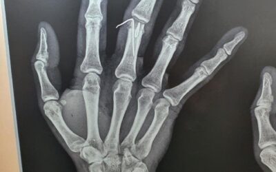 20 Years Male Suffered From Injury Of The Right Middle Finger