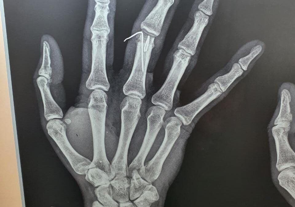 20 Years Male Suffered From Injury Of The Right Middle Finger