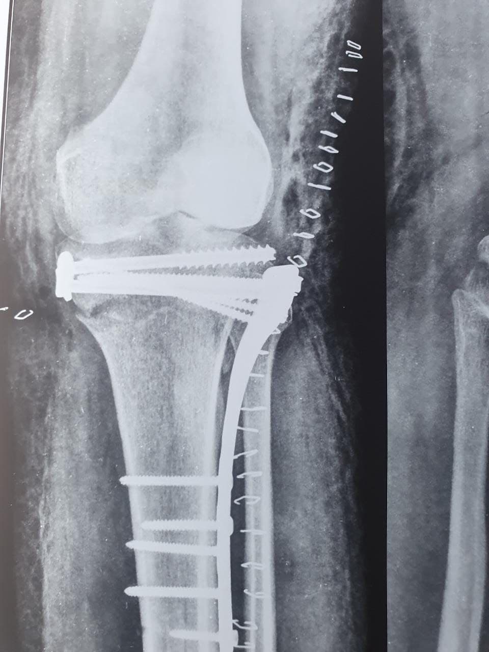 20 Years Old Female Sustained Comminuted Bicondylar Fracture Tibia Left10