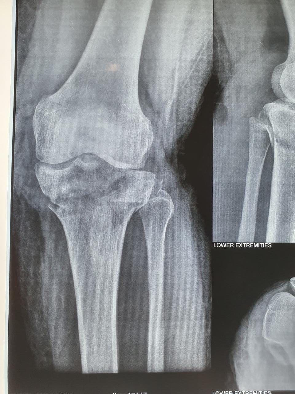 20 Years Old Female Sustained Comminuted Bicondylar Fracture Tibia Left7