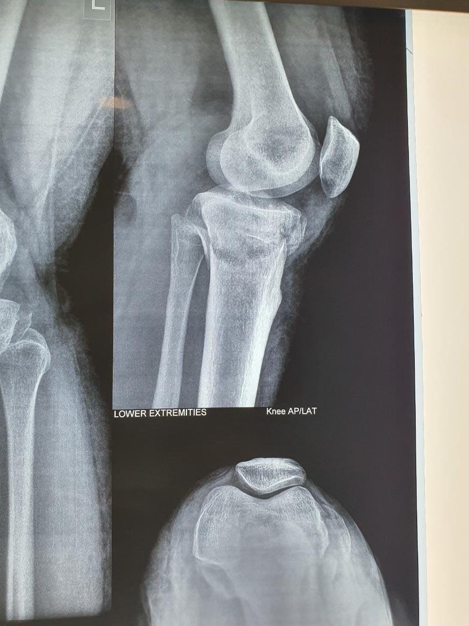20 Years Old Female Sustained Comminuted Bicondylar Fracture Tibia Left8