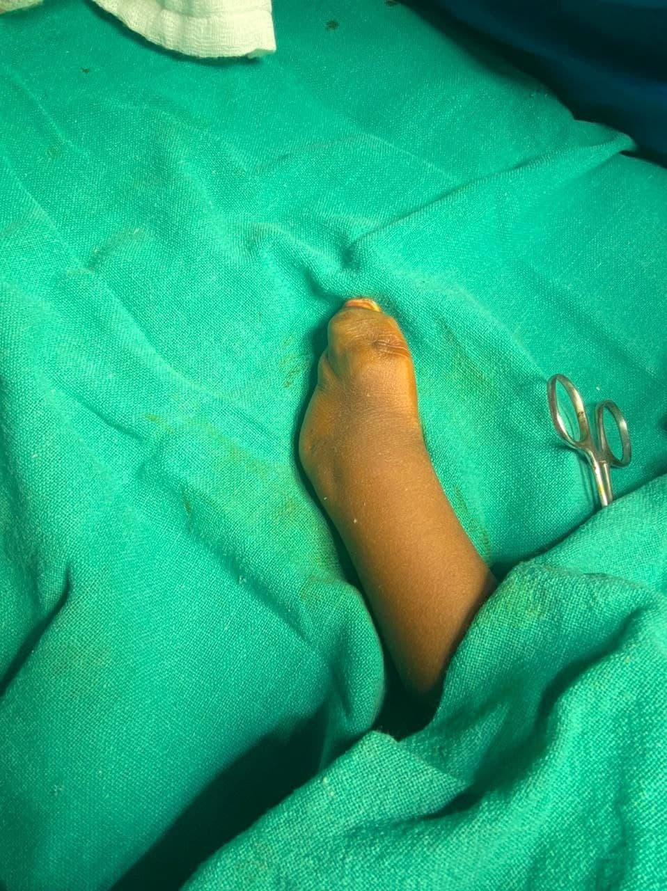 3 Years Old Child With Complex Hand Deformity Left11 3 Years Old Child With Complex Hand Deformity Left11