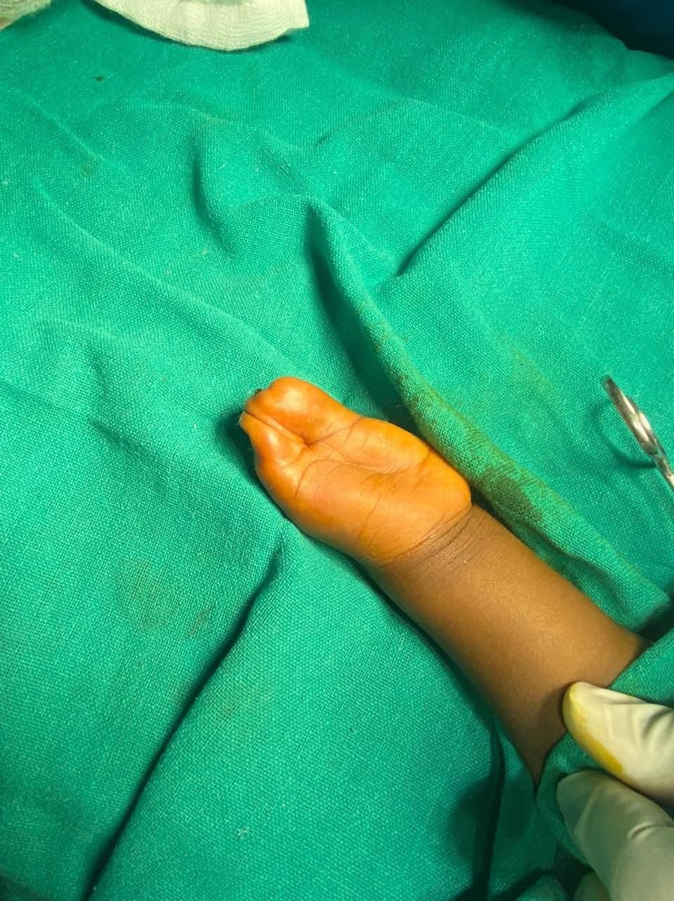 3 Years Old Child With Complex Hand Deformity Left4 3 Years Old Child With Complex Hand Deformity Left4