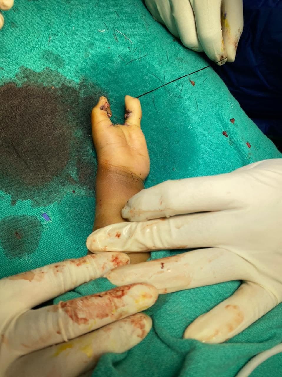 3 Years Old Child With Complex Hand Deformity Left9 3 Years Old Child With Complex Hand Deformity Left9