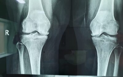 42 Years Old Female Was Suffering From Osteonecrosis | Dr. Neelabh