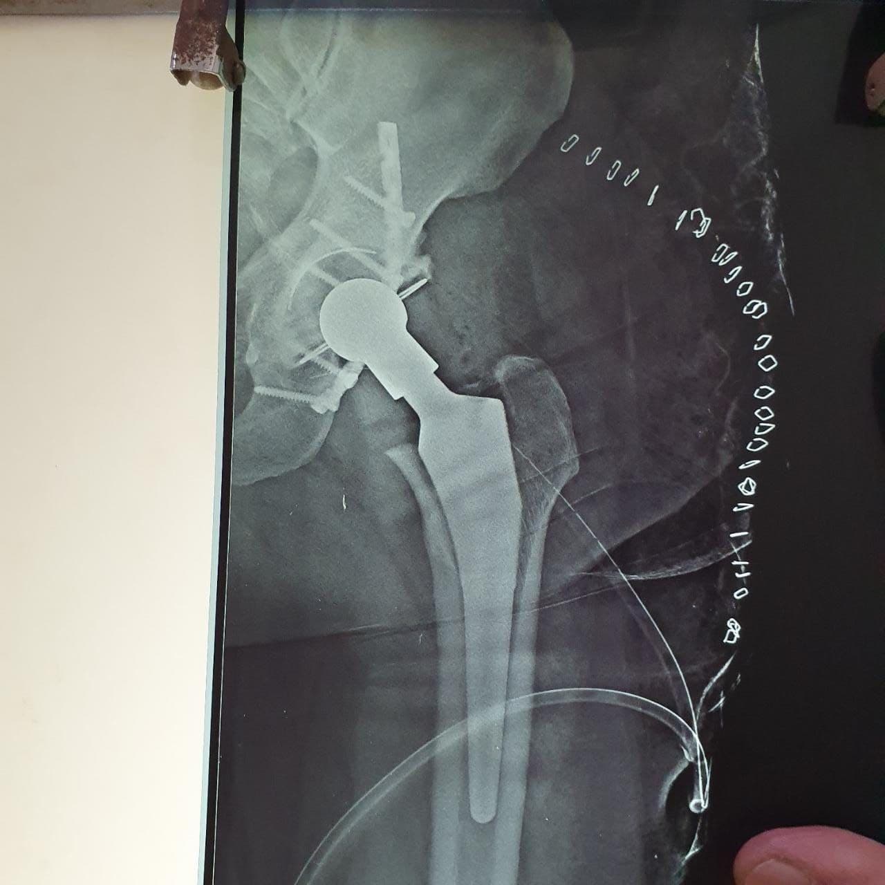46 Years Old Male Total Hip Replacement Surgery Dr. Neelabh2