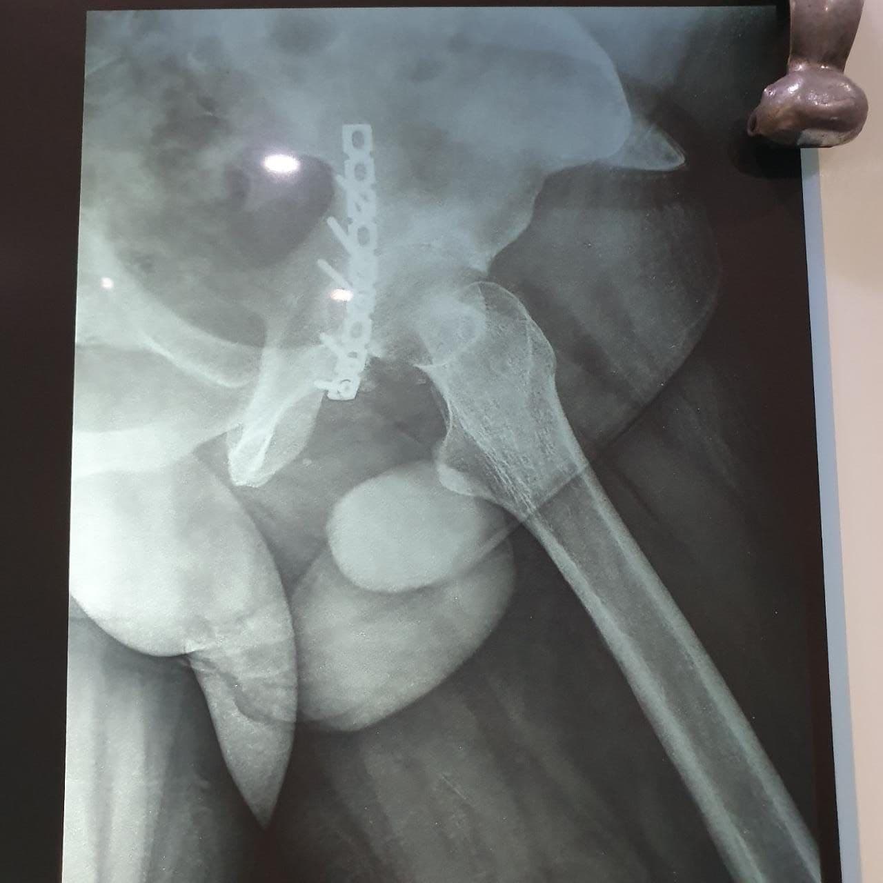 46 Years Old Male Total Hip Replacement Surgery Dr. Neelabh3