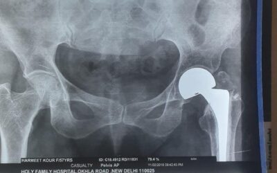 57 Years Old Female Sustained Fracture Neck Femur Left