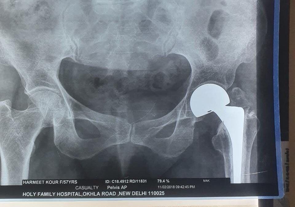 57 Years Old Female Sustained Fracture Neck Femur Left