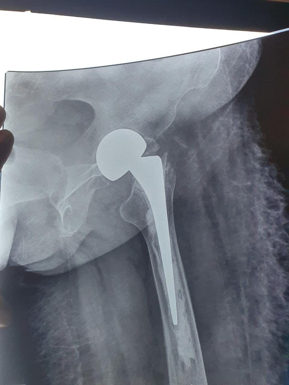 57 Years Old Female Sustained Fracture Neck Femur Left1 57 Years Old Female Sustained Fracture Neck Femur Left1