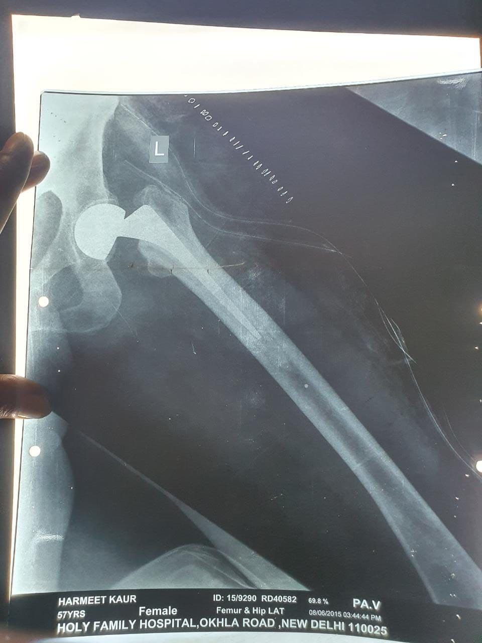 57 Years Old Female Sustained Fracture Neck Femur Left2 57 Years Old Female Sustained Fracture Neck Femur Left2