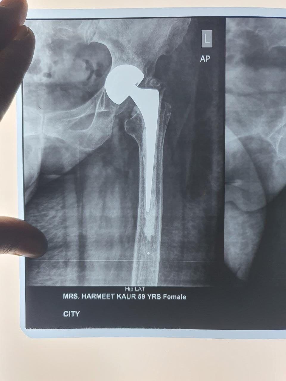 57 Years Old Female Sustained Fracture Neck Femur Left3 57 Years Old Female Sustained Fracture Neck Femur Left3