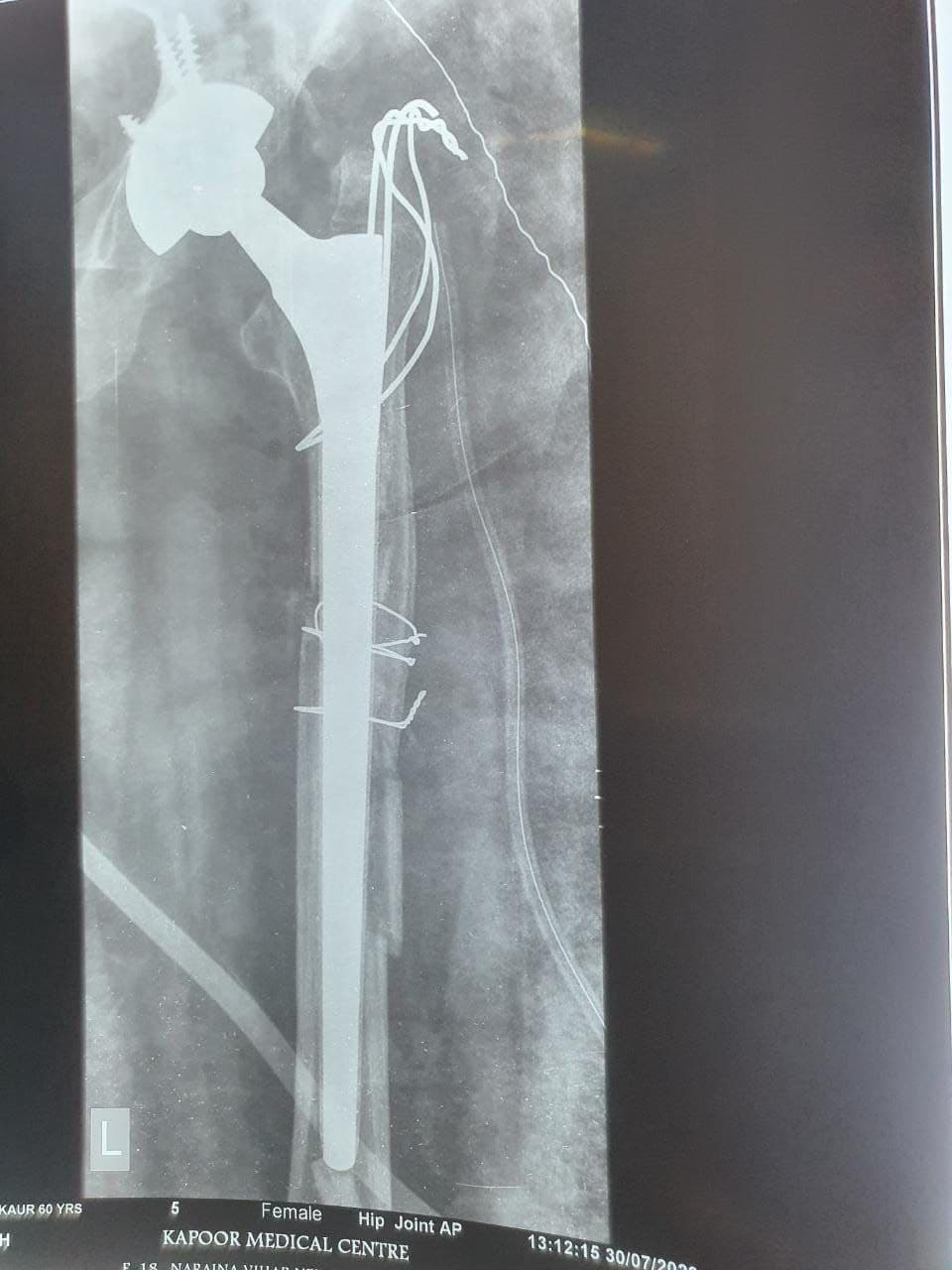 57 Years Old Female Sustained Fracture Neck Femur Left4 57 Years Old Female Sustained Fracture Neck Femur Left4