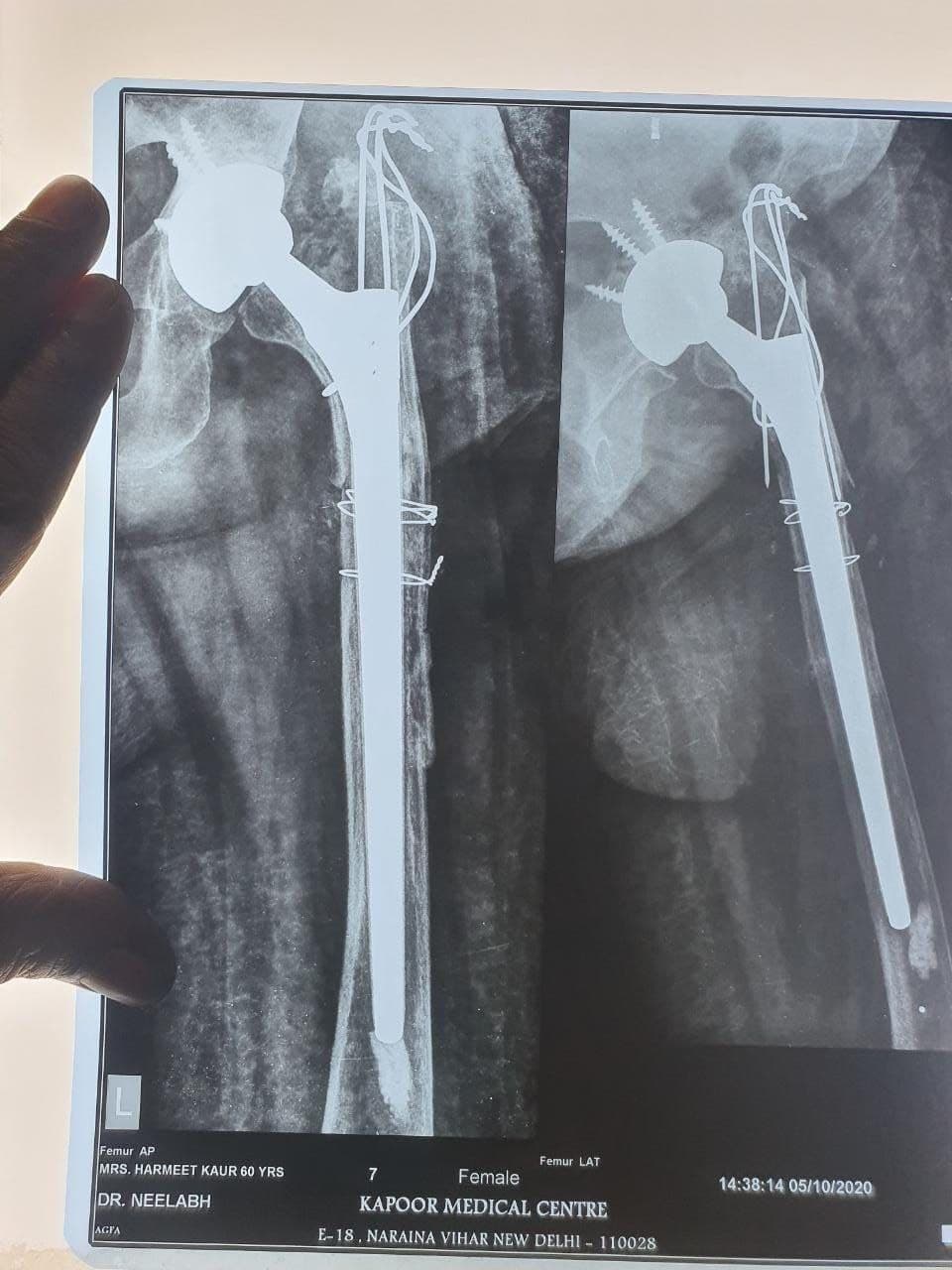 57 Years Old Female Sustained Fracture Neck Femur Left5