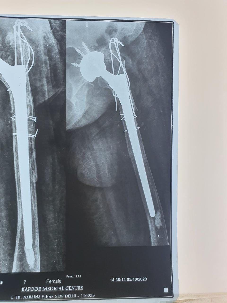 57 Years Old Female Sustained Fracture Neck Femur Left6 57 Years Old Female Sustained Fracture Neck Femur Left6