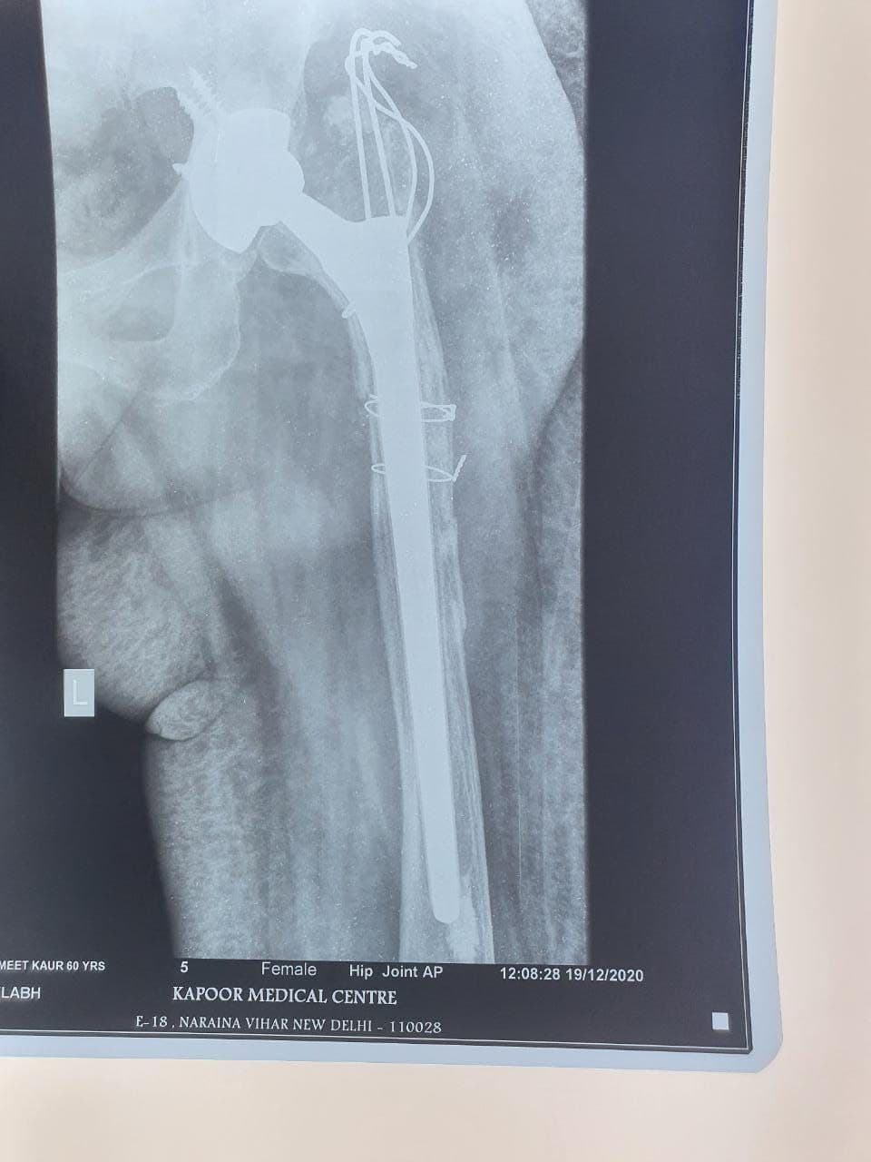 57 Years Old Female Sustained Fracture Neck Femur Left7 57 Years Old Female Sustained Fracture Neck Femur Left7