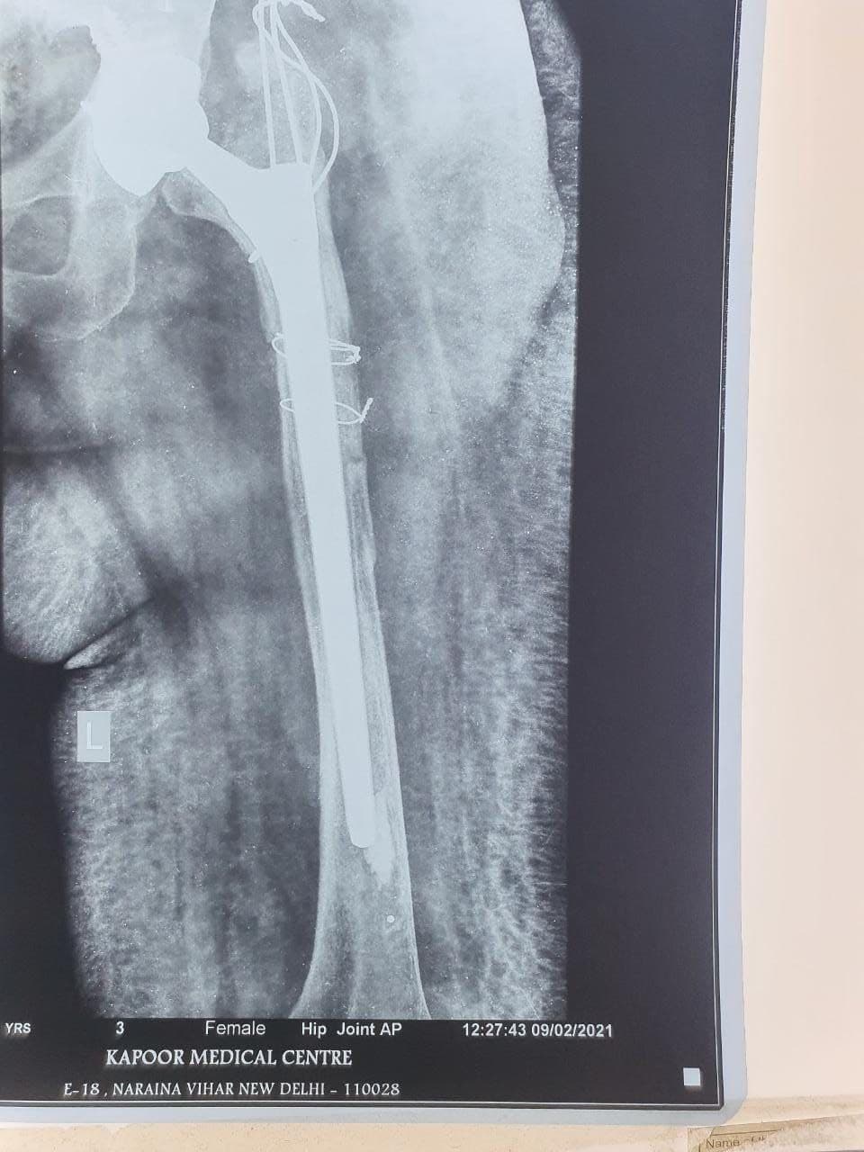 57 Years Old Female Sustained Fracture Neck Femur Left8 57 Years Old Female Sustained Fracture Neck Femur Left8