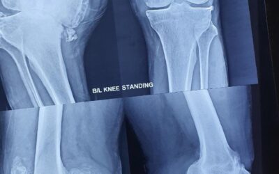 62 Years Male With Severe Osteoarthritis | Total Knee Replacement