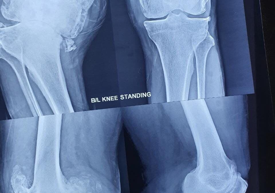 62 Years Male With Severe Osteoarthritis Total Knee Replacement