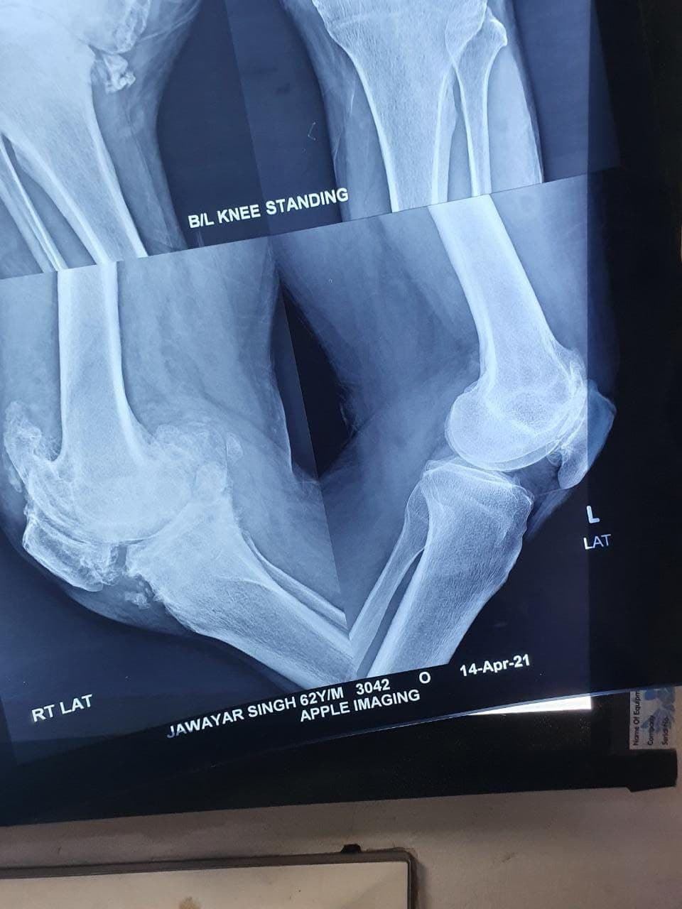 62 Years Male With Severe Osteoarthritis Total Knee Replacement1