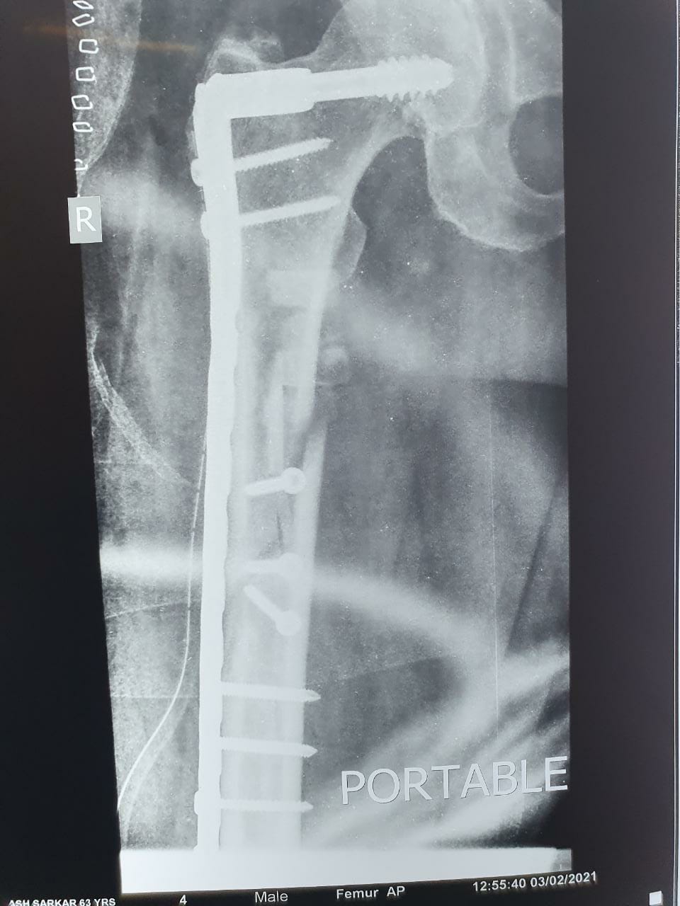 63 Years Old Male Suffered Fracture Of Right Upper Femur Bone (Thigh Bone)2