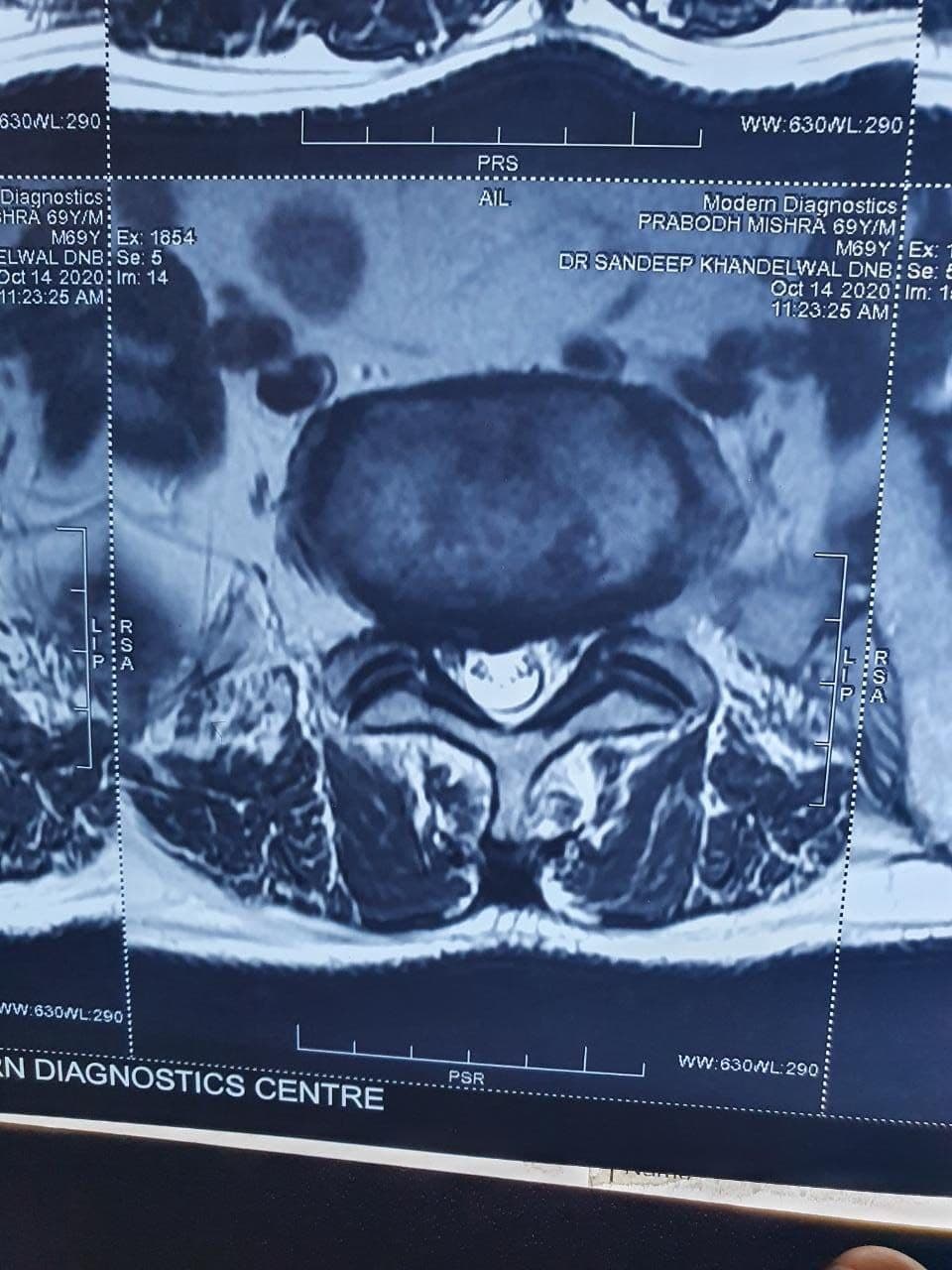 69 Years Old Male Suffering From Disc Prolapse Dr. Neelabh1