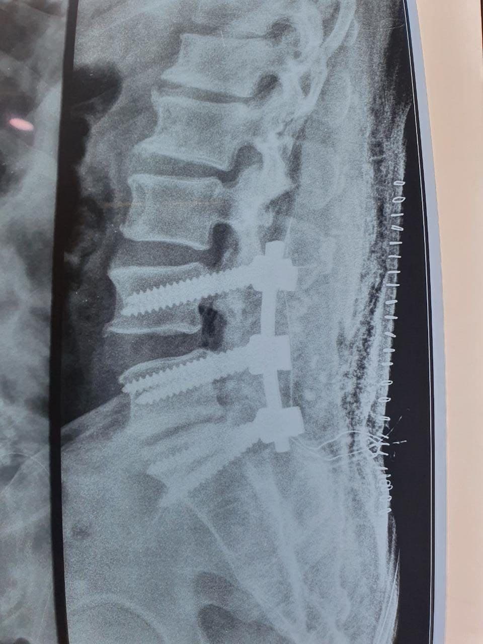 69 Years Old Male Suffering From Disc Prolapse Dr. Neelabh4