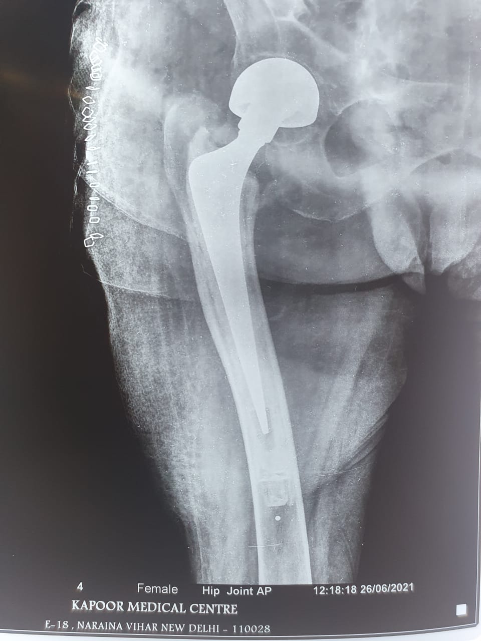 70 Years old lady suffered from fracture neck1