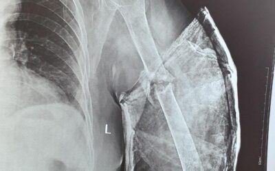 75 Years Old Female Presented With 9 Months Old Non-United Fracture