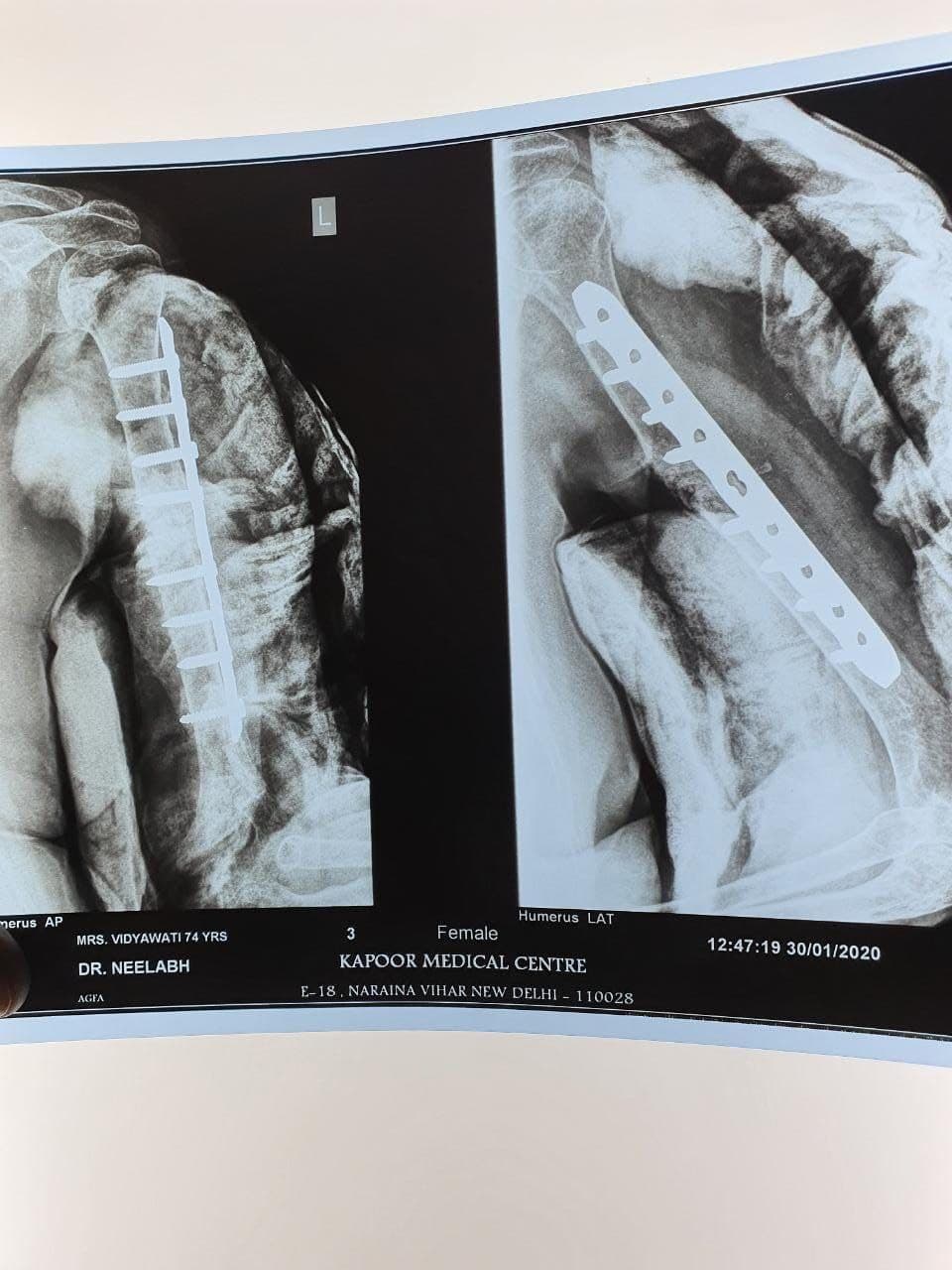 75 Years Old Female Presented With 9 Months Old Non-United Fracture1