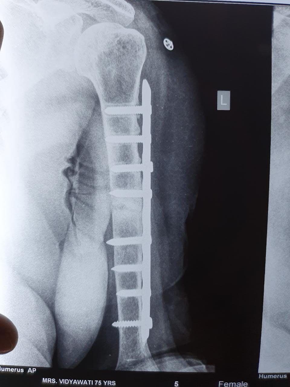 75 Years Old Female Presented With 9 Months Old Non-United Fracture3 75 Years Old Female Presented With 9 Months Old Non-United Fracture3