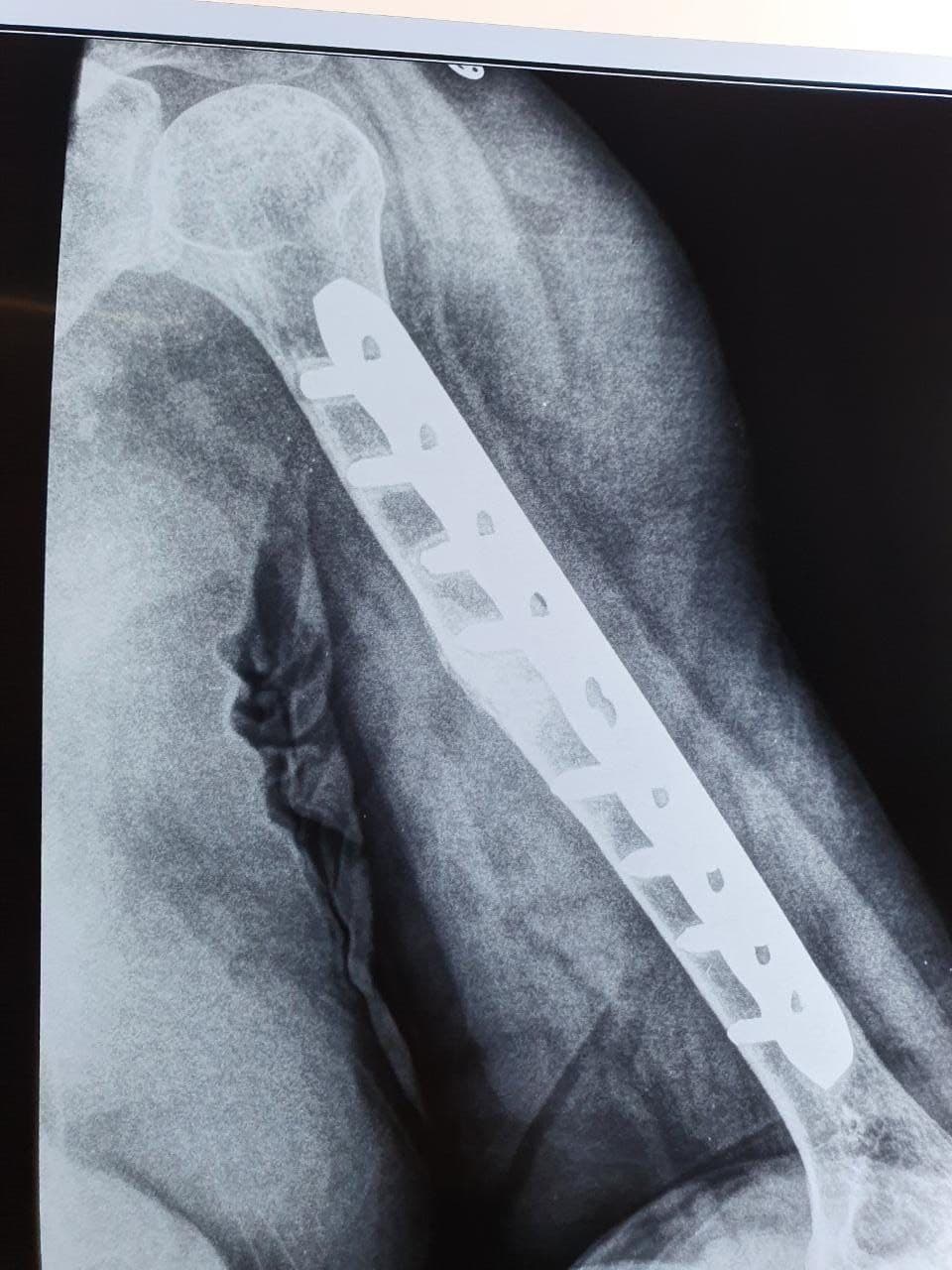 75 Years Old Female Presented With 9 Months Old Non-United Fracture4 75 Years Old Female Presented With 9 Months Old Non-United Fracture4