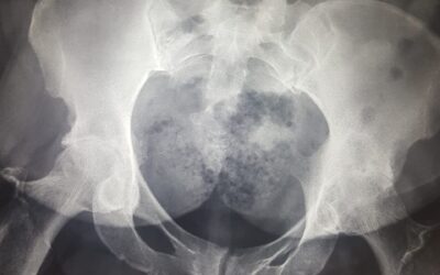 Advantages Of Hip Joint Replacement Surgery In India