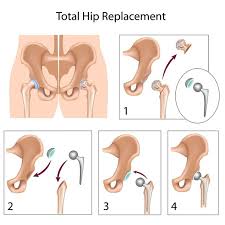 Average Cost of Hip Replacement Surgery in India