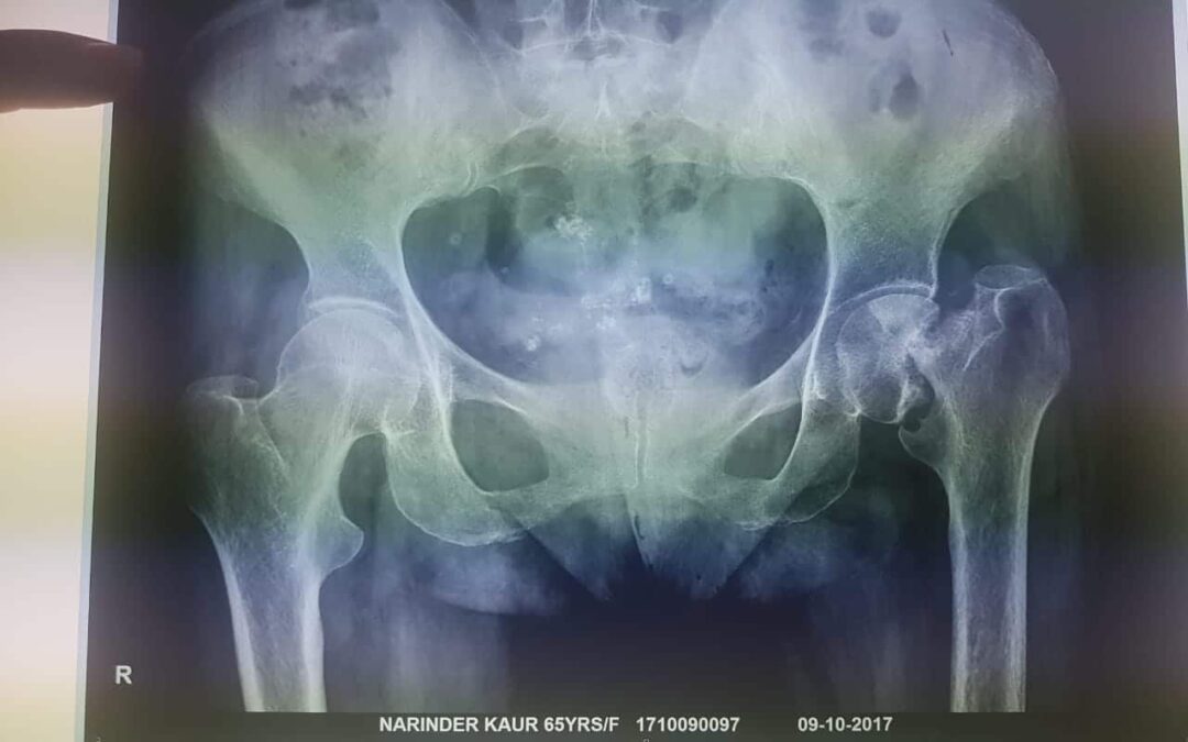 Dr. Neelabh The Best Hip Replacement Surgeon in India