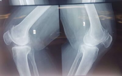 Dr. Neelabh The Best Knee Replacement Surgeon in India