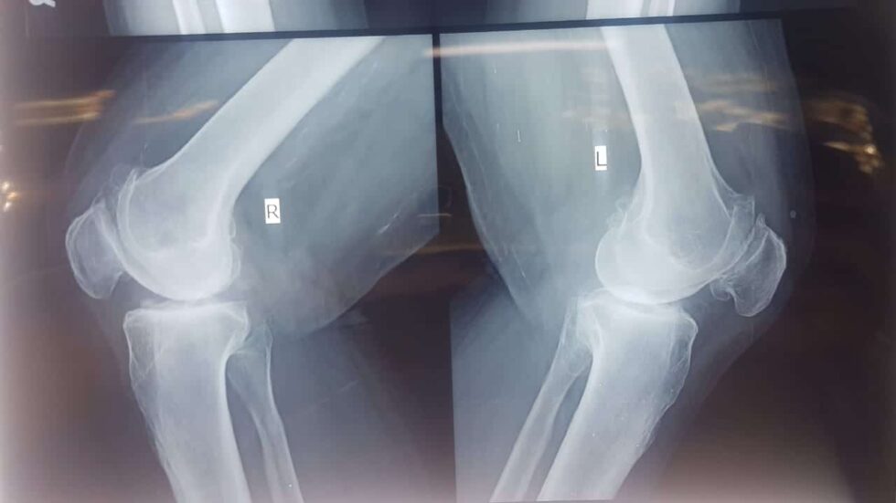 Dr. Neelabh The Best Knee Replacement Surgeon In India