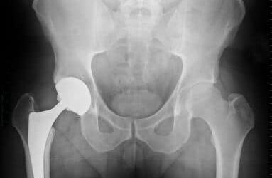 Hip Joint Replacement Surgery in India: An Overview