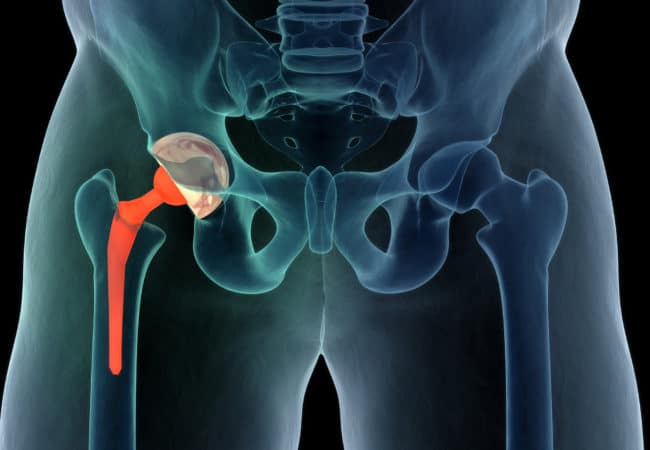 Joint Replacement Surgeries High In India