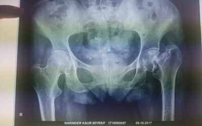 Joint Replacement surgery in India