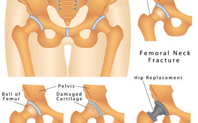 Knee and Hip Surgery in India