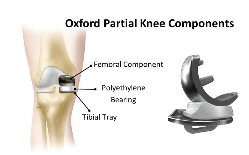 Oxford Partial Knee Replacement
