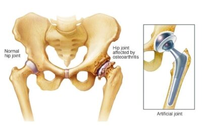 Speedy Recovery From Knee and Hip Replacement Surgery