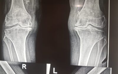 The Best Joint Replacement Surgery in India
