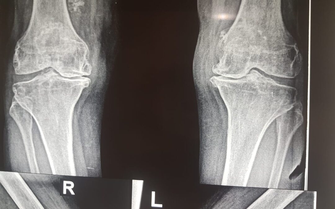 Things Nobody Told You About Hip And Knee Replacement In India