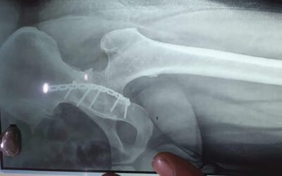 Total Hip Replacement of a 45 years old male