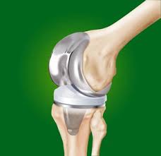 Types of Knee Replacement Implants